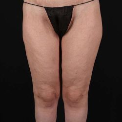 Thigh Lift Before & After Patient #1756