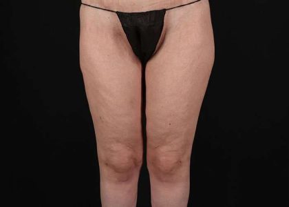 Thigh Lift Before & After Patient #1756