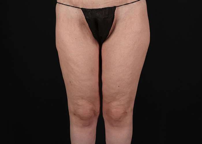 Thigh Lift Before & After Patient #1756