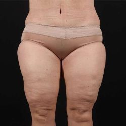 Thigh Lift Before & After Patient #1762