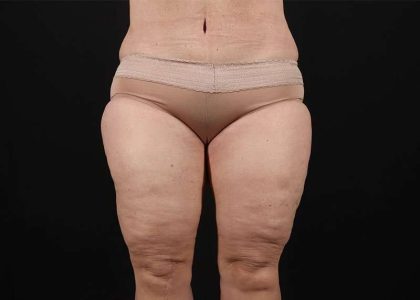 Thigh Lift Before & After Patient #1762