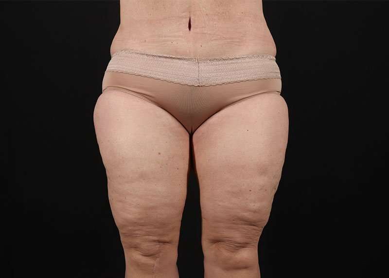 Thigh Lift Before & After Patient #1762