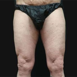 Thigh Lift Before & After Patient #1776