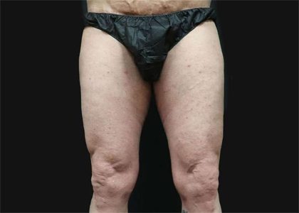 Thigh Lift Before & After Patient #1776