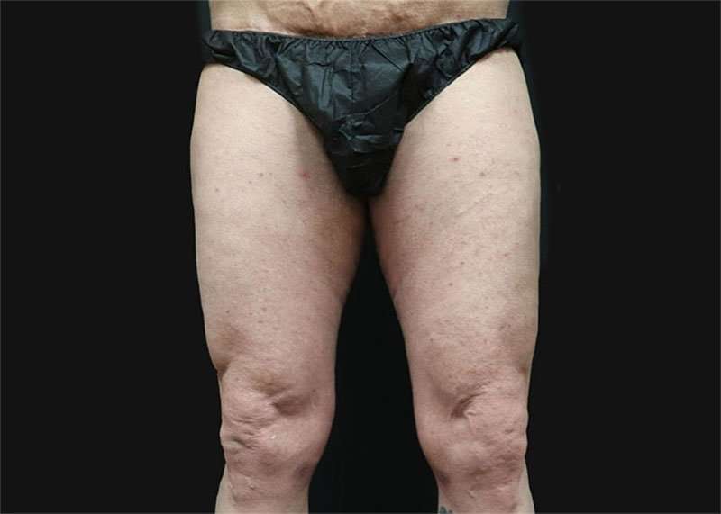 Thigh Lift Before & After Patient #1776