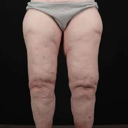 Thigh Lift Before & After Patient #1790