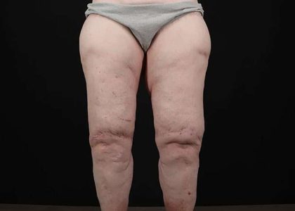 Thigh Lift Before & After Patient #1790