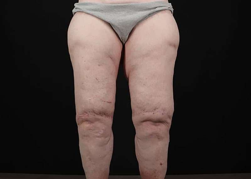 Thigh Lift Before & After Patient #1790