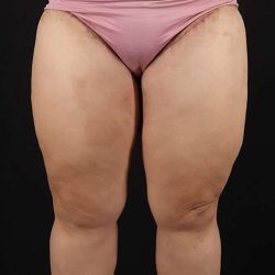 Thigh Lift Before & After Patient #1804