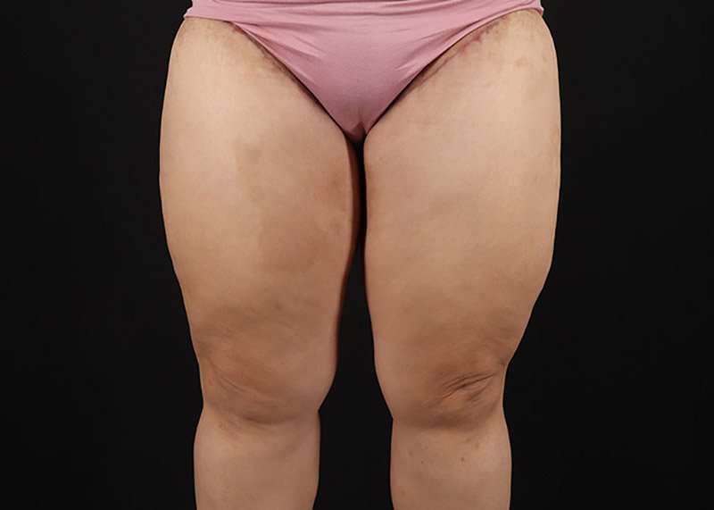 Thigh Lift Before & After Patient #1804