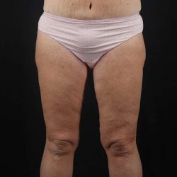 Thigh Lift Before & After Patient #1818