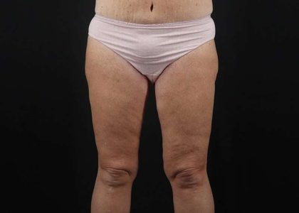 Thigh Lift Before & After Patient #1818
