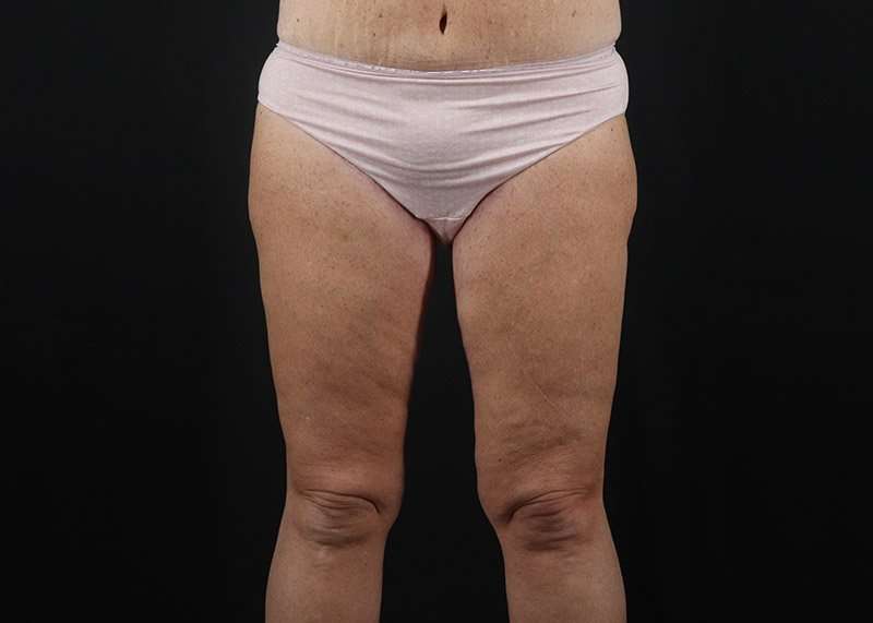 Thigh Lift Before & After Patient #1818