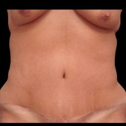 Abdominoplasty (Tummy Tuck) Before & After Patient #680