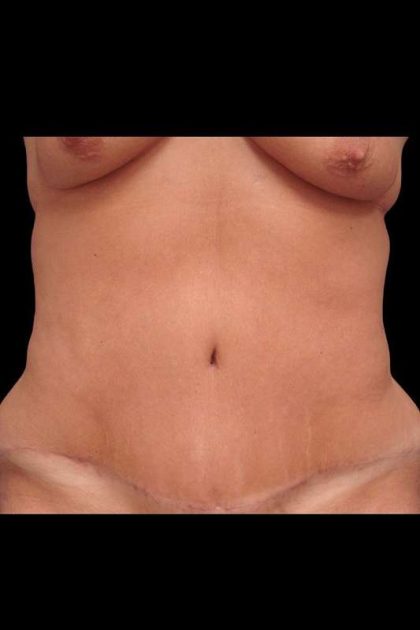 Abdominoplasty (Tummy Tuck) Before & After Patient #680