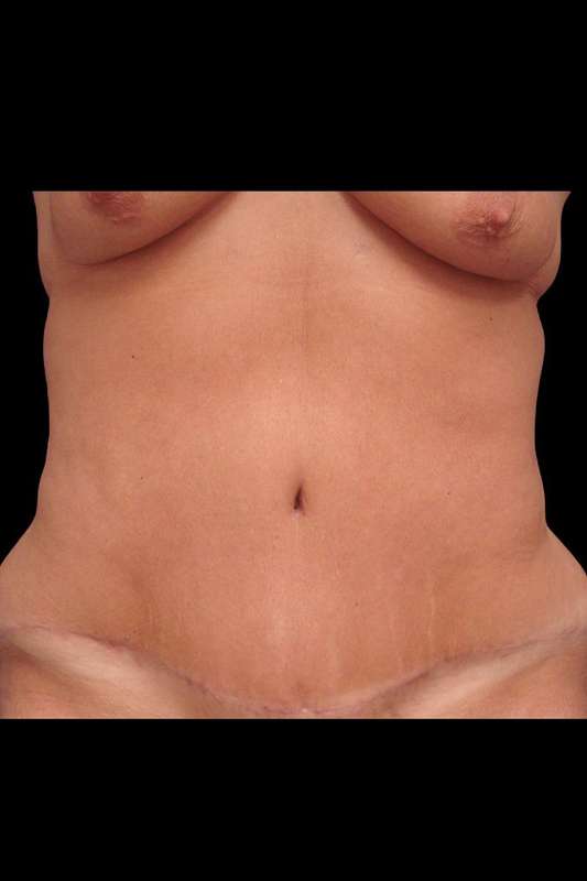 Abdominoplasty (Tummy Tuck) Before & After Patient #680