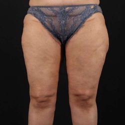 Thigh Lift Before & After Patient #1831