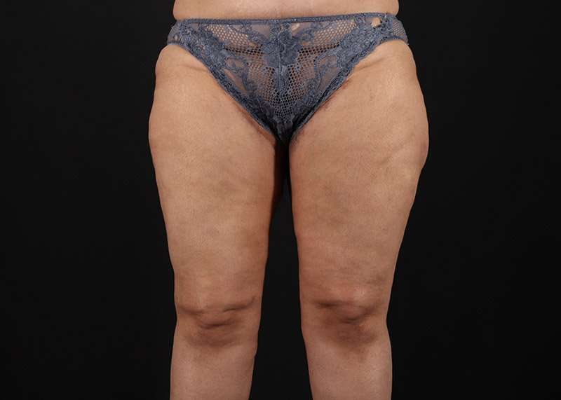 Thigh Lift Before & After Patient #1831