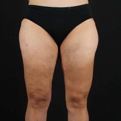 Thigh Lift Before & After Patient #1844