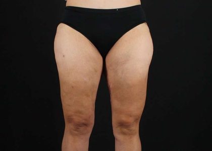 Thigh Lift Before & After Patient #1844