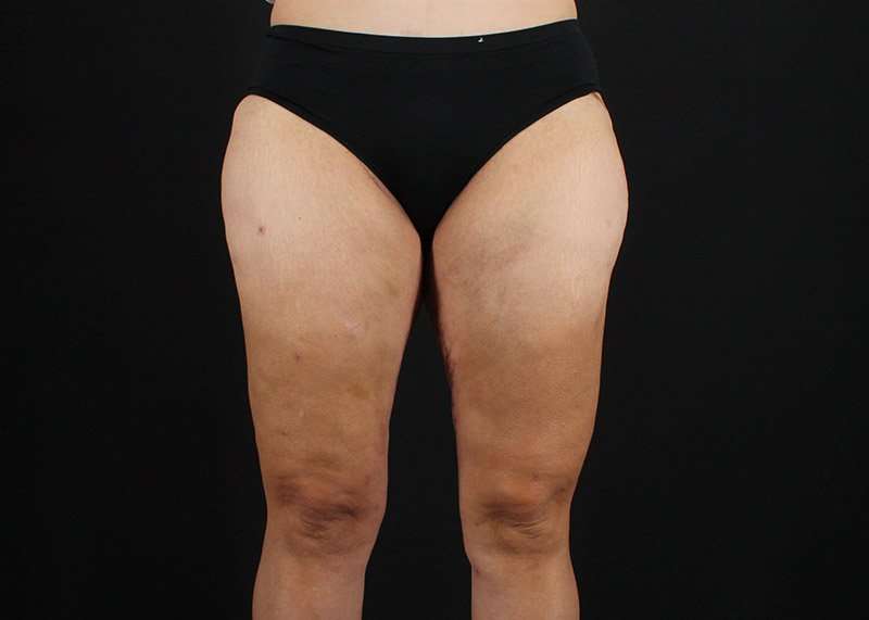 Thigh Lift Before & After Patient #1844