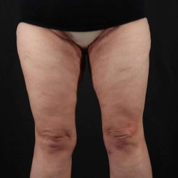 Thigh Lift Before & After Patient #1857