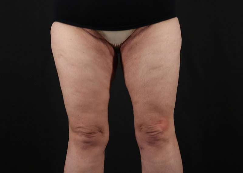 Thigh Lift Before & After Patient #1857