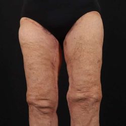 Thigh Lift Before & After Patient #1871