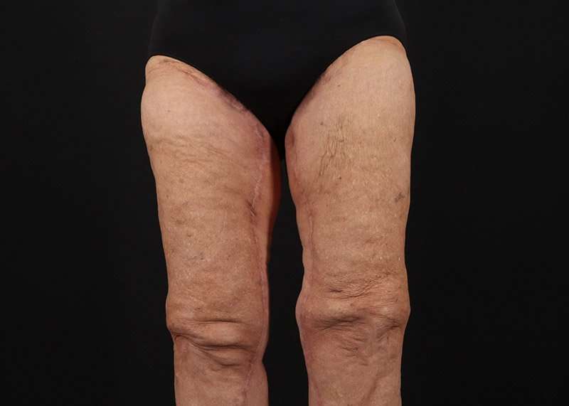 Thigh Lift Before & After Patient #1871