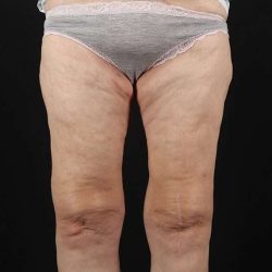 Thigh Lift Before & After Patient #1884