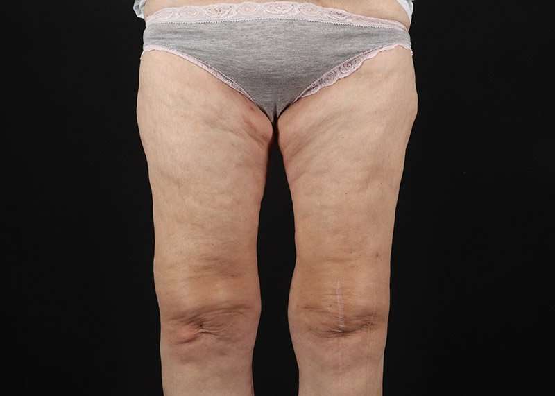 Thigh Lift Before & After Patient #1884
