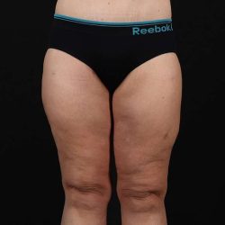 Thigh Lift Before & After Patient #1897