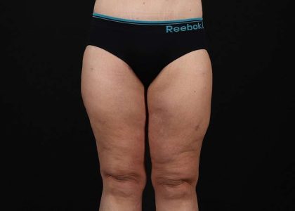 Thigh Lift Before & After Patient #1897