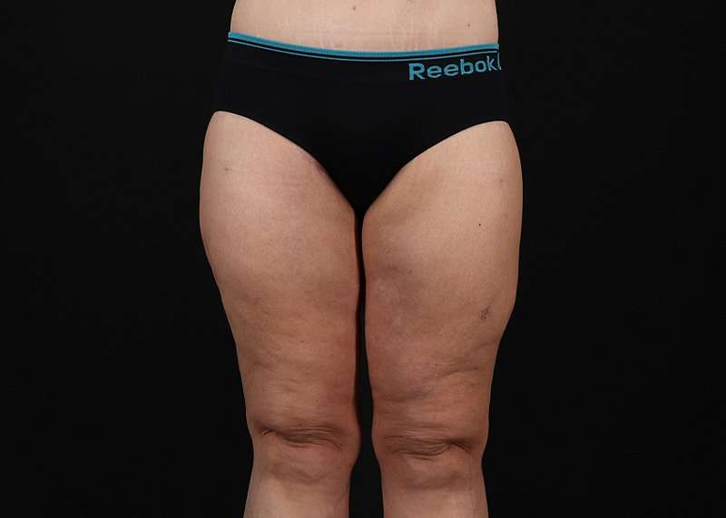 Thigh Lift Before & After Patient #1897