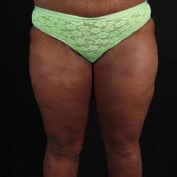 Thigh Lift Before & After Patient #1911