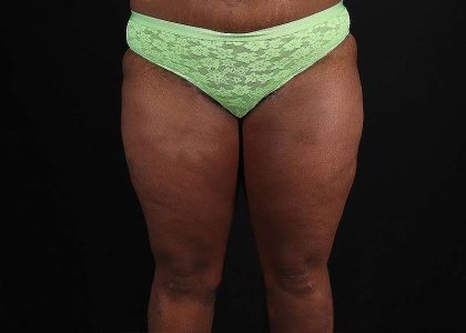 Thigh Lift Before & After Patient #1911