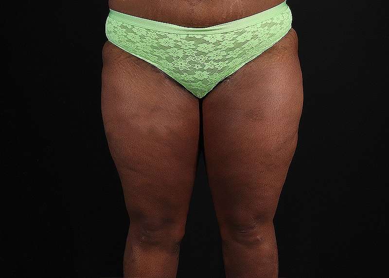 Thigh Lift Before & After Patient #1911