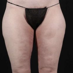 Thigh Lift Before & After Patient #1925