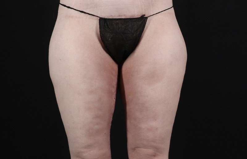 Thigh Lift Before & After Patient #1925