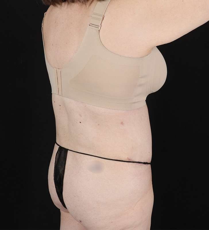 Back Lift/Tuck Before & After Patient #1939