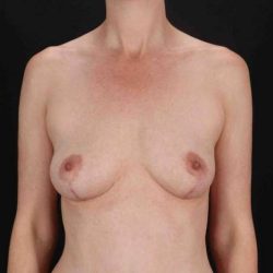 Breast Augmentation w/ Fat Transfer Before & After Patient #2004