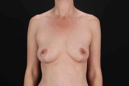 Breast Augmentation w/ Fat Transfer Before & After Patient #2004