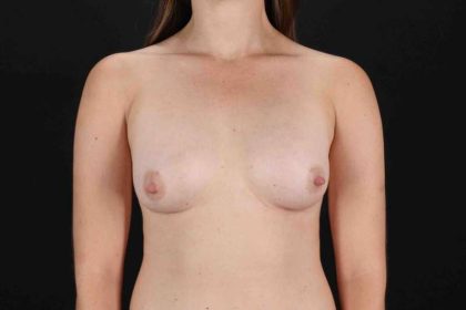 Breast Augmentation w/ Fat Transfer Before & After Patient #2027