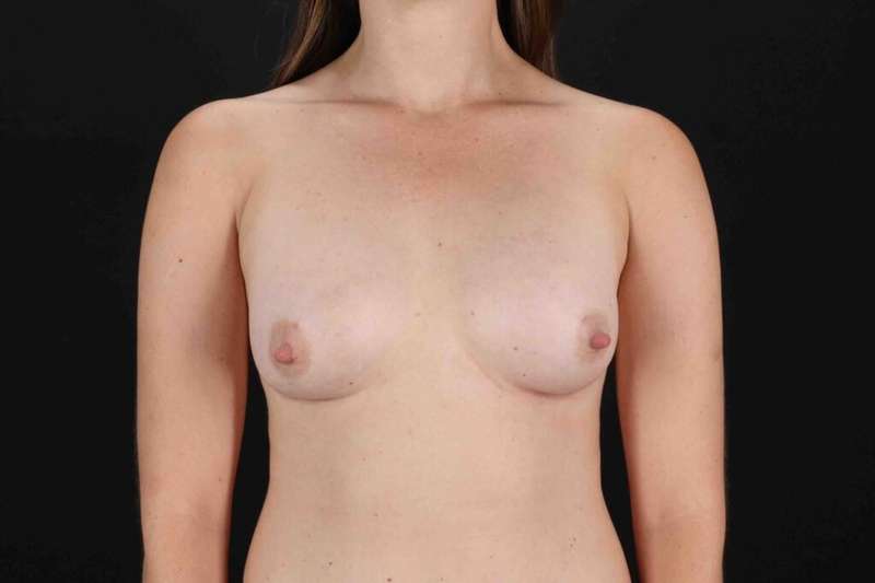 Breast Augmentation w/ Fat Transfer Before & After Patient #2027
