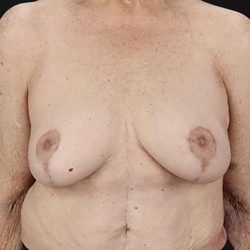 Breast Augmentation w/ Fat Transfer Before & After Patient #2049