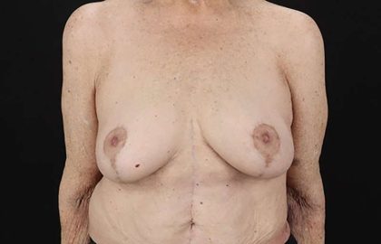 Breast Augmentation w/ Fat Transfer Before & After Patient #2049