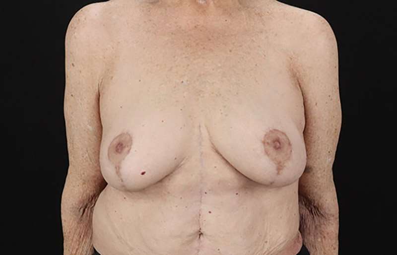 Breast Augmentation w/ Fat Transfer Before & After Patient #2049