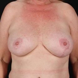 Breast Augmentation w/ Fat Transfer Before & After Patient #2062