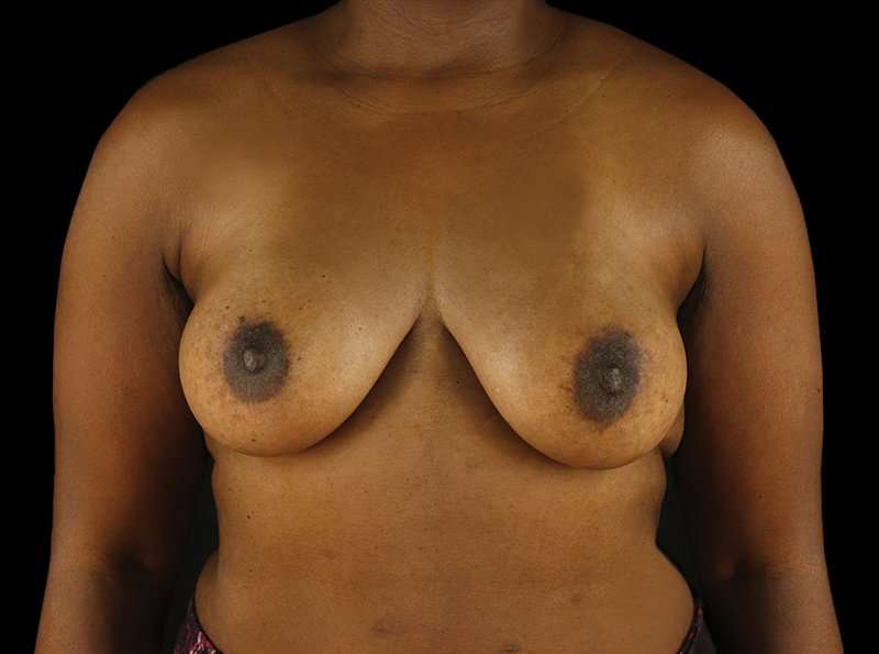 Breast Augmentation Before & After Patient #2121