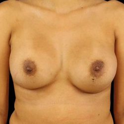 Breast Augmentation Before & After Patient #2129